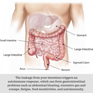 Things to Know About Leaky Gut Syndrome