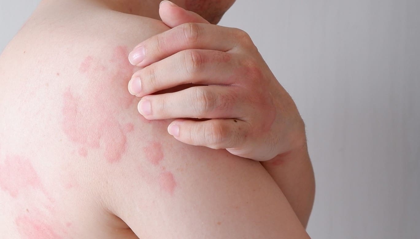 hives on skin